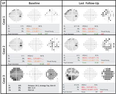 Case Report: Successful treatment of external beam radiation-induced optic papillopathy with intravitreal anti-VEGF